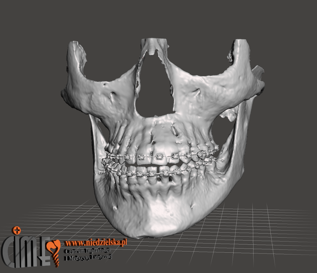 Druk modelu 3D całej czaszki pacjenta