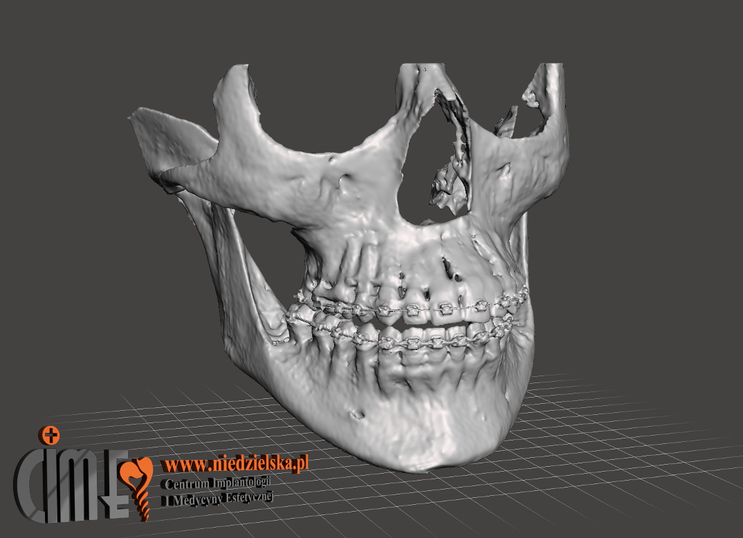 Projektowanie i wydruk modelu 3D całej czaszki pacjenta