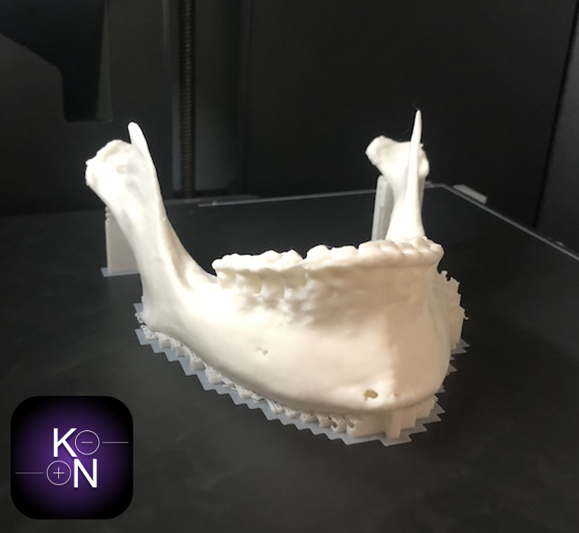 Model 3D szczęki dolnej wydrukowany w technologii FDM prawa strona